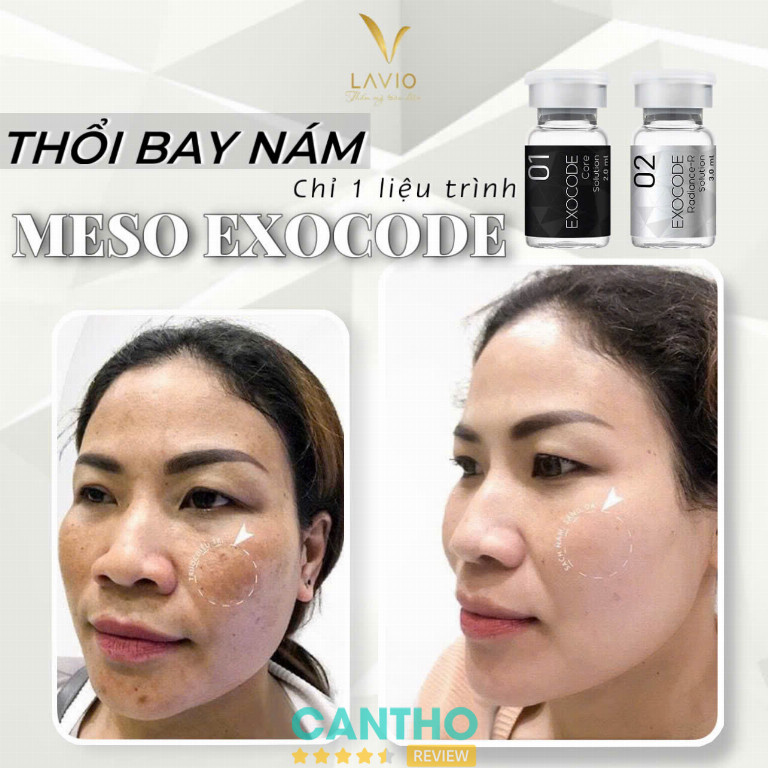 LAVIO Spa & Clinic Cần Thơ chuyên điều trị nám, tàn nhang 
