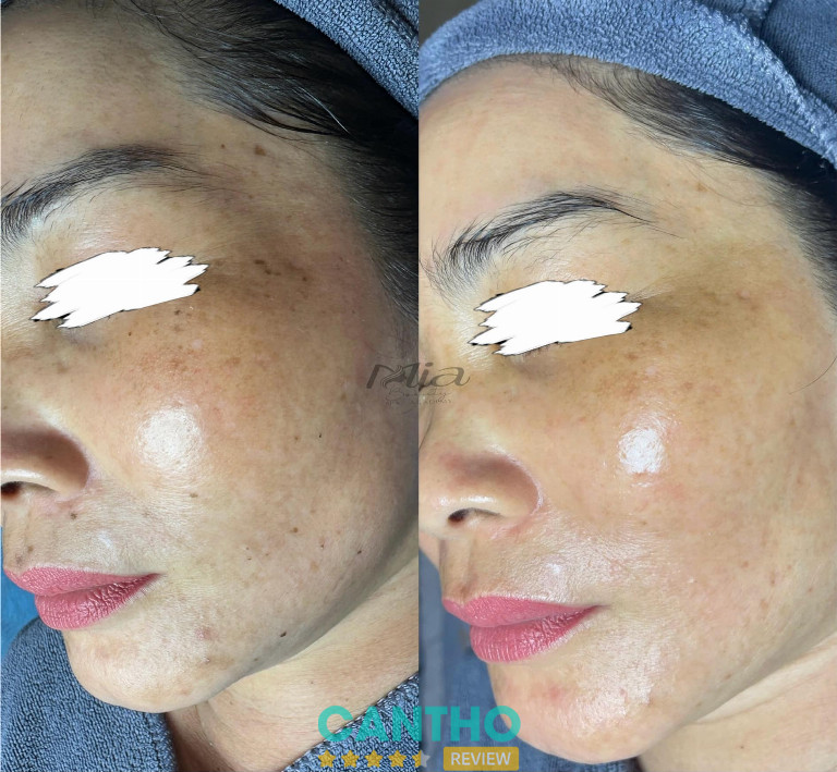 Mia Spa Cần Thơ chuyên trị nám, tàn nhang tại cần thơ