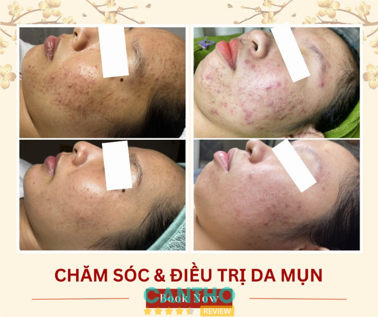 Lona Home Spa trị mụn tại Cần Thơ 