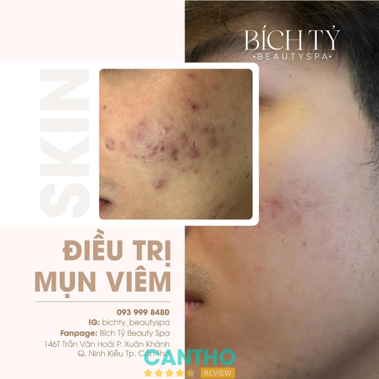 Bích Tỷ Beauty Spa trị mụn tại cần thơ