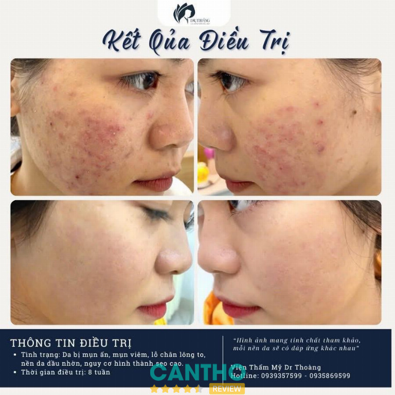 Dr.Thoang Dermacos tại Cần Thơ cung cấp dịch vụ trị mụn