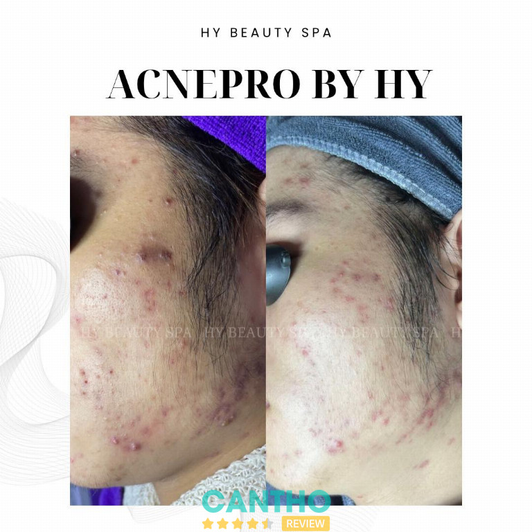 Hi Beauty Spa cung cấp dịch vụ spa trị mụn tại Cần Thơ