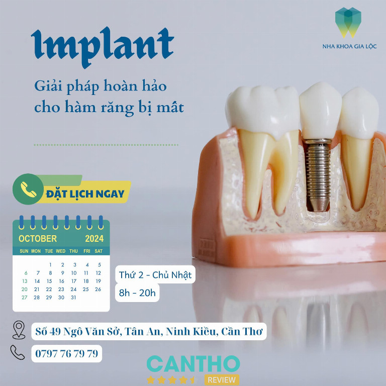 Nha Khoa Gia Lộc cung cấp dịch vụ trồng răng Implant tại cần thơ