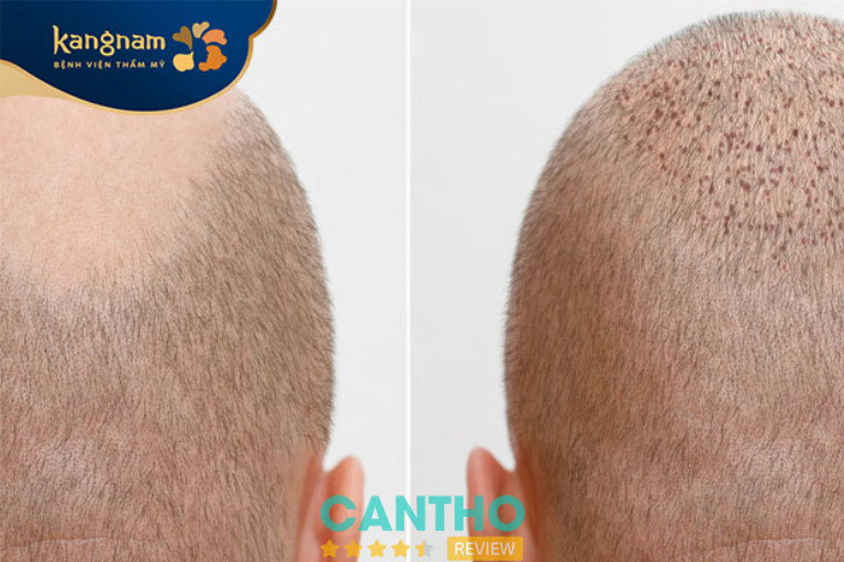 Viện Thẩm Mỹ Kangnam là Địa chỉ cấy tóc, cấy mày ở Cần Thơ giá rẻ