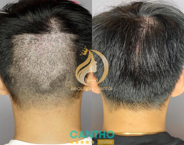 Địa chỉ cấy tóc, cấy mày ở Cần Thơ Phòng Khám Thẩm Mỹ Nari 