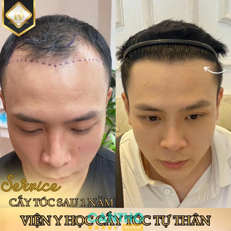 Viện Y Học Cấy Tóc Tự Thân cấy tóc ở Cần Thơ