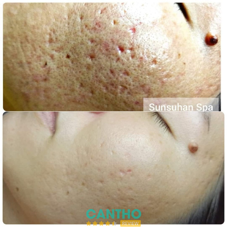 Địa chỉ trị sẹo lồi ở Cần Thơ  Sunsuhan Spa