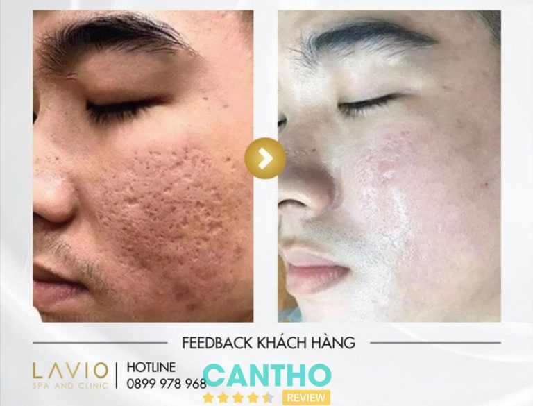 spa trị sẹo tại Cần Thơ  LAVIO Spa & Clinic