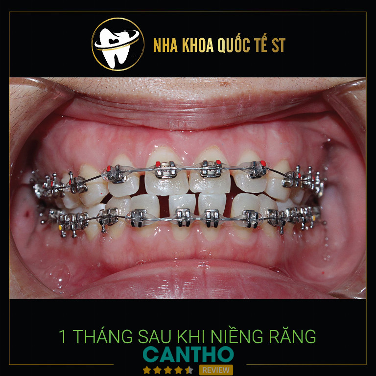 địa chỉ niềng răng ở Sóc Trăng - Nha khoa Quốc Tế