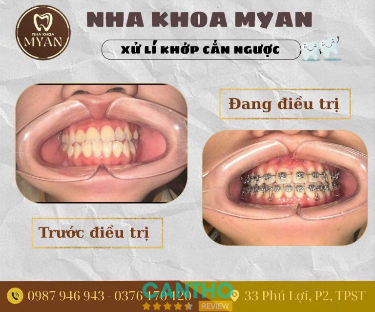 địa chỉ niềng răng ở Sóc Trăng - Nha khoa Thẩm mỹ MYAN
