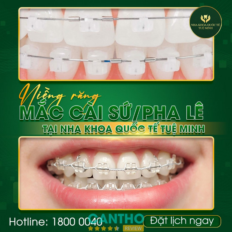 địa chỉ niềng răng tại Sóc Trăng - Nha khoa Quốc tế Tuệ Minh