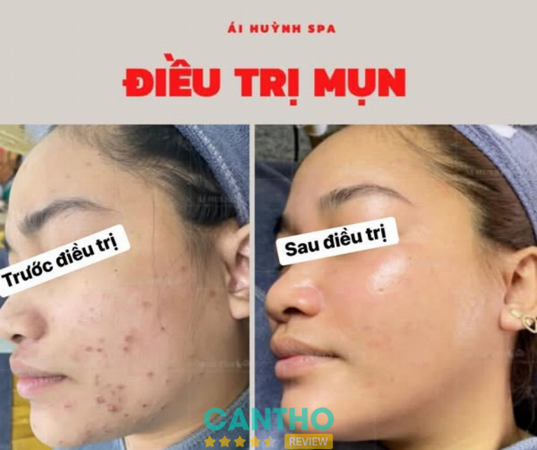 Ái Huỳnh Spa là địa chỉ trị mụn ở Ngã Bảy hiệu quả