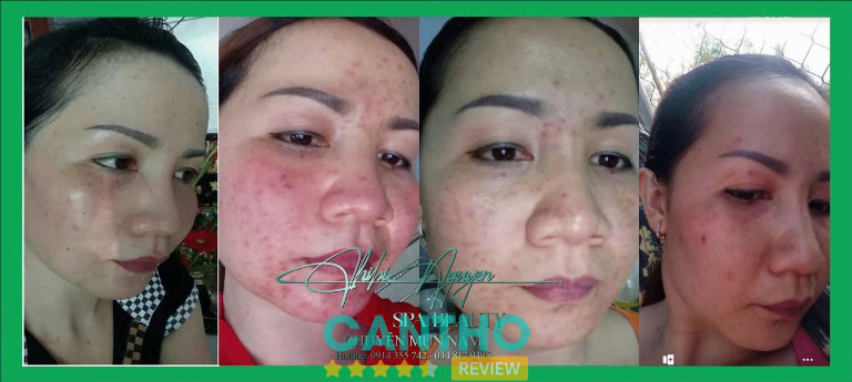Chibi Nguyễn Spa trị mụn ở Ngã Bảy
