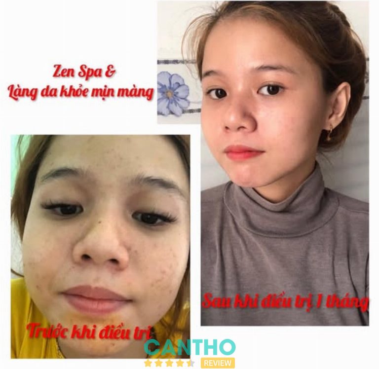 Zen Spa trị mụn ở Sóc Trăng 