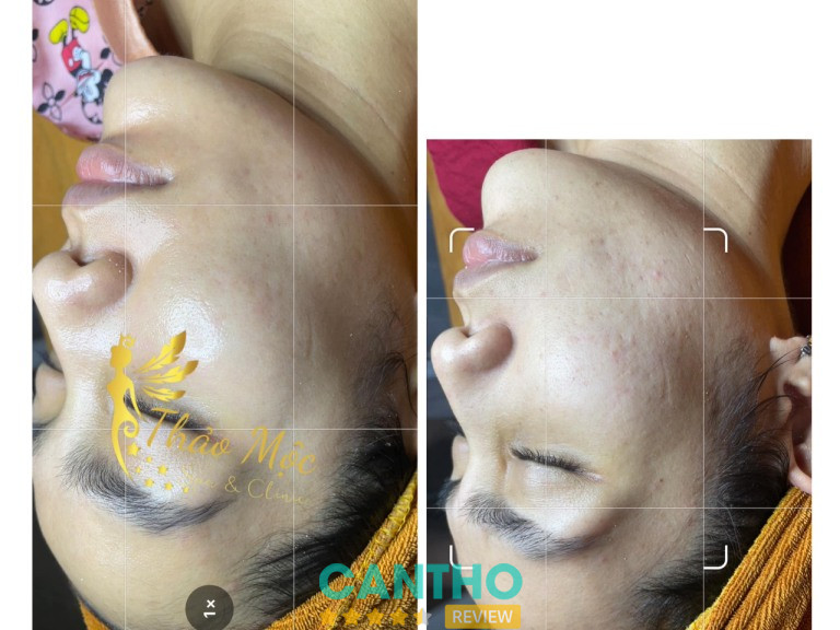 Thảo Mộc Spa trị mụn ở Vị Thanh