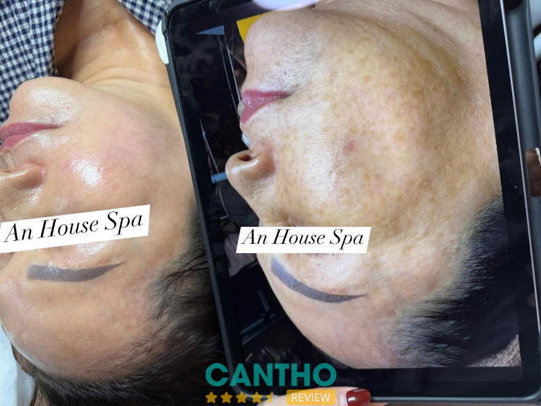 An House Spa là Địa chỉ trị nám da tàn nhang hiệu quả ở Sóc Trăng