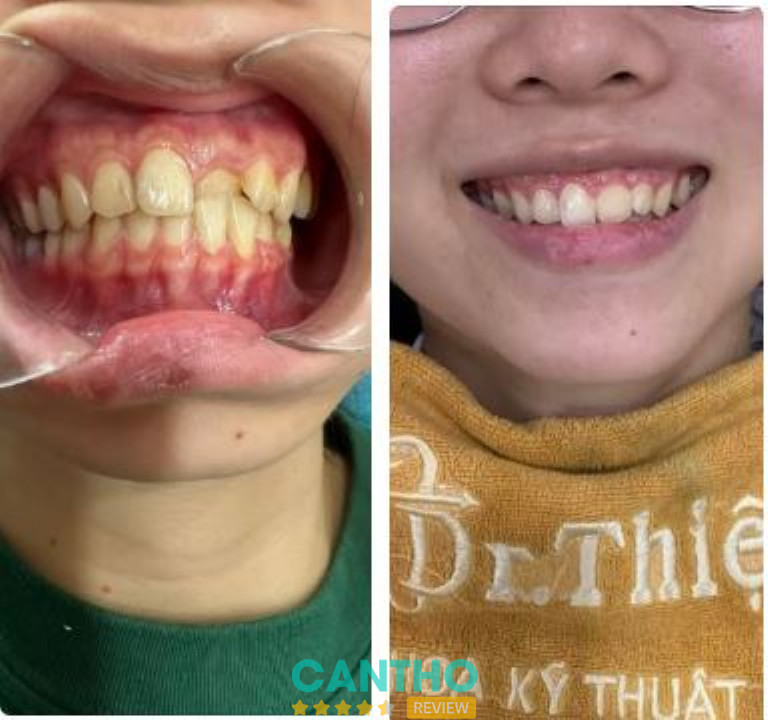 Địa chỉ niềng răng ở Ngã Bảy - Nha Khoa Kỹ Thuật Cao Dr. Thiện