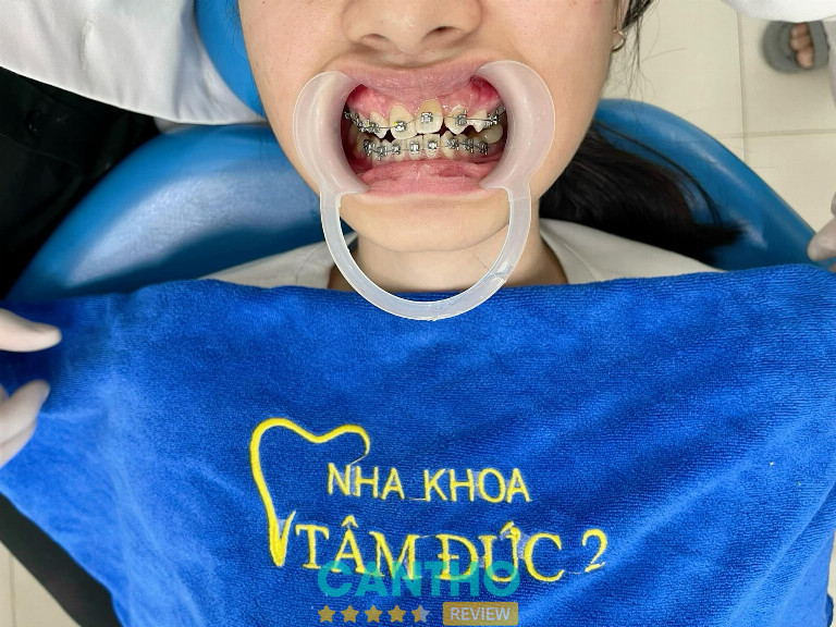 Nha Khoa Tâm Đức 2 niềng răng tại Ngã Bảy