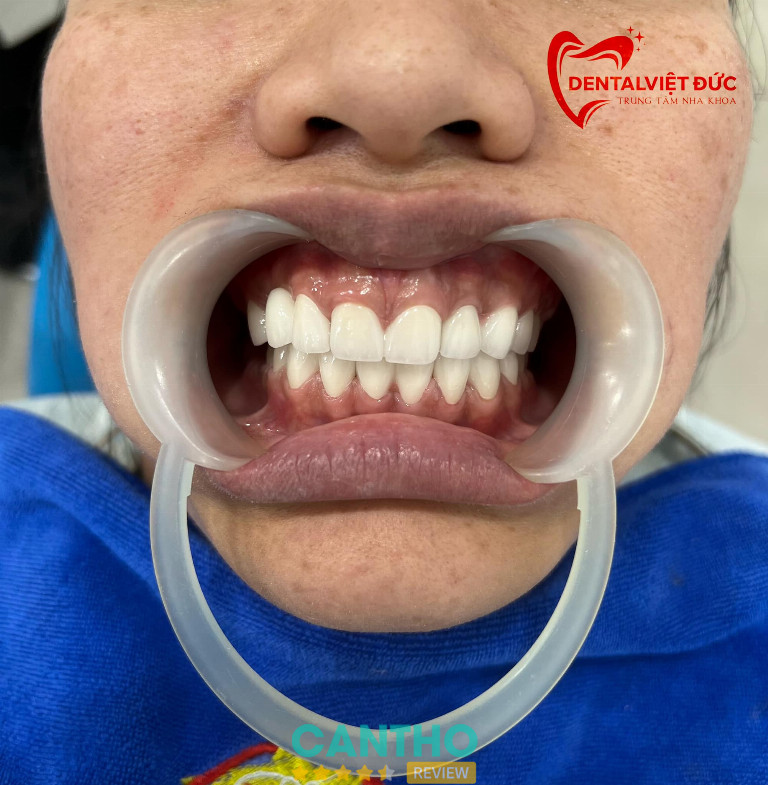 Nha Khoa Việt Đức là Địa chỉ niềng răng ở Ngã Bảy uy tín