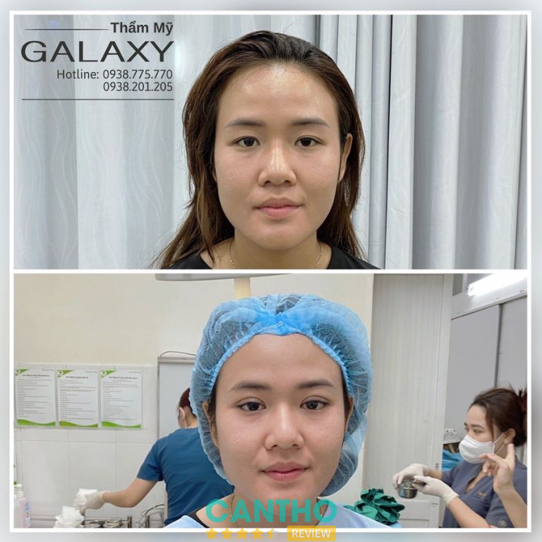 Địa chỉ cắt mí ở Cần Thơ