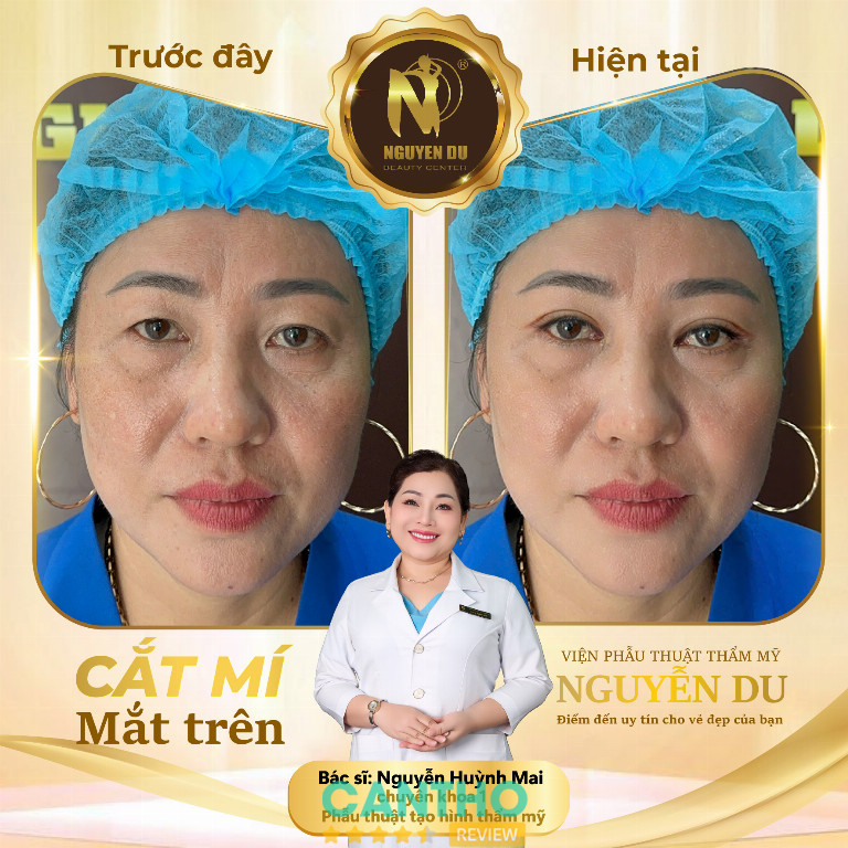 Địa chỉ cắt mí mắt ở Cần Thơ