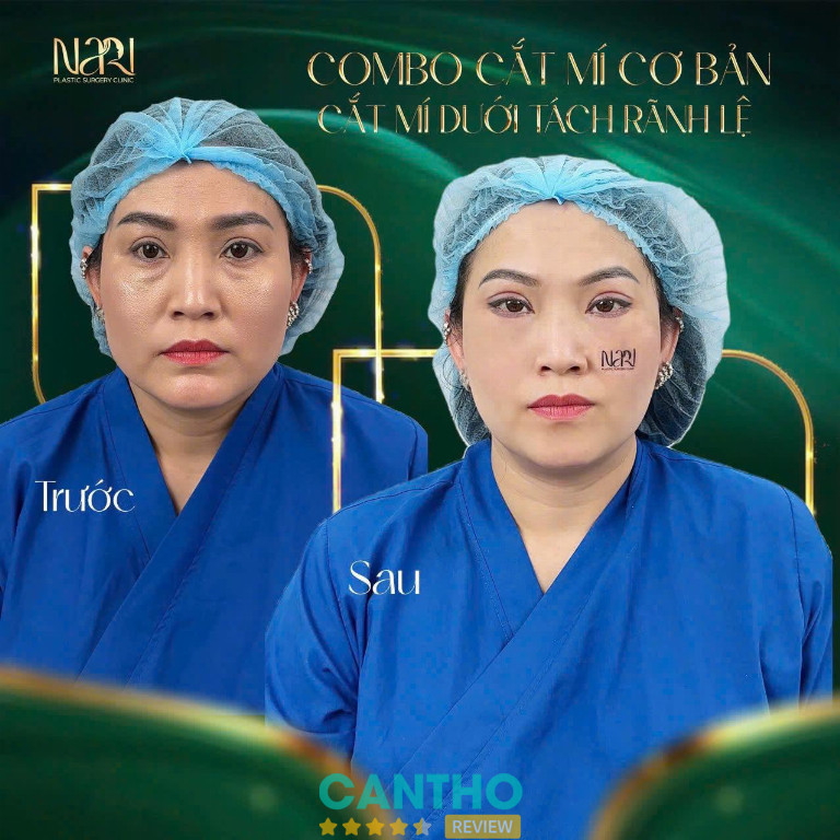 cắt mí mắt Cần Thơ