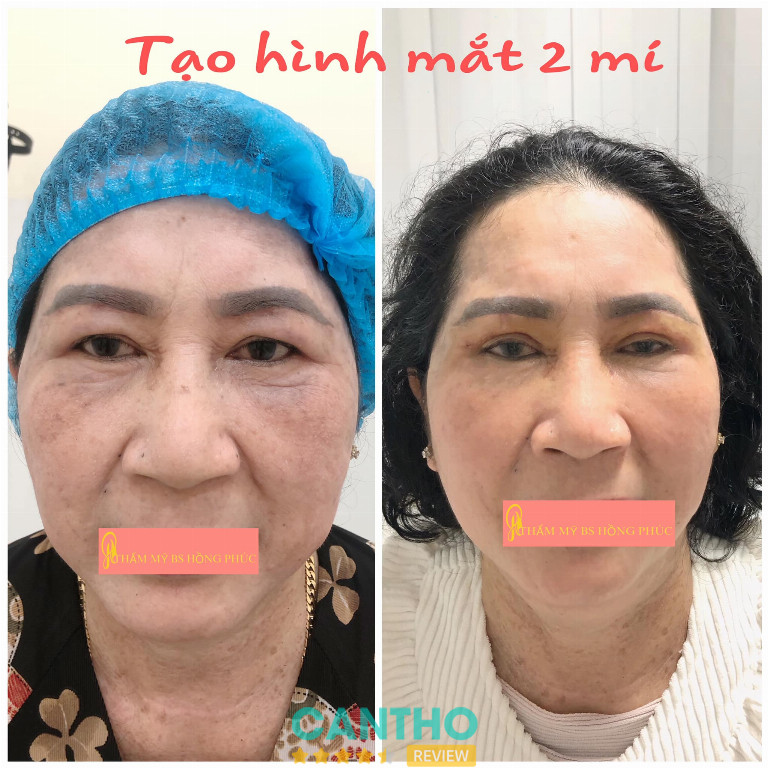 cắt mí ở Cần Thơ giá rẻ