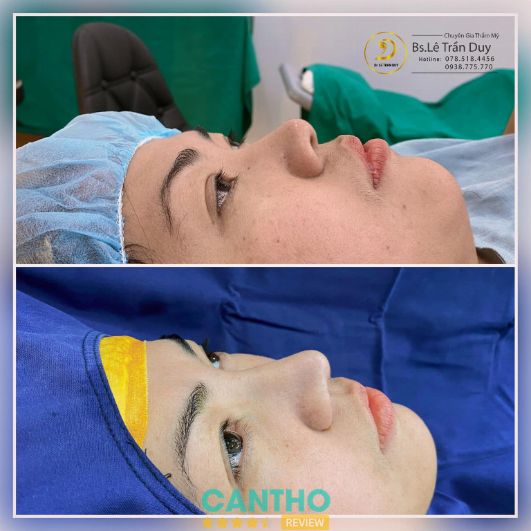 Địa chỉ nâng mũi ở Cần Thơ 