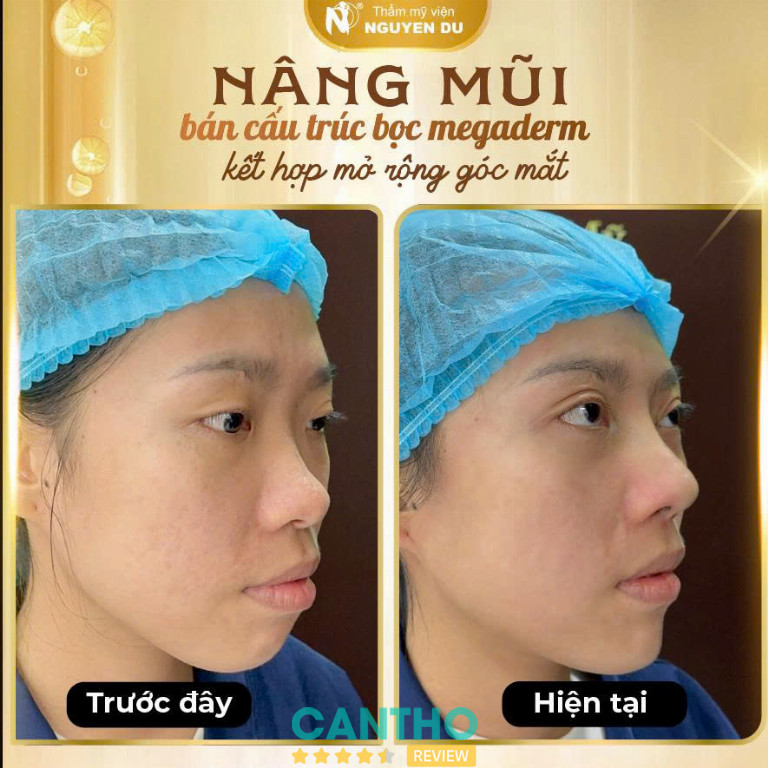 Thẩm Mỹ Viện Nguyễn Du nâng mũi ở Cần Thơ