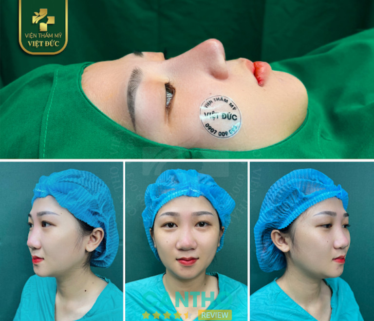 Thẩm mỹ viện nâng mũi ở Cần Thơ 