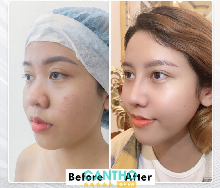 nâng mũi uy tín Cần Thơ 