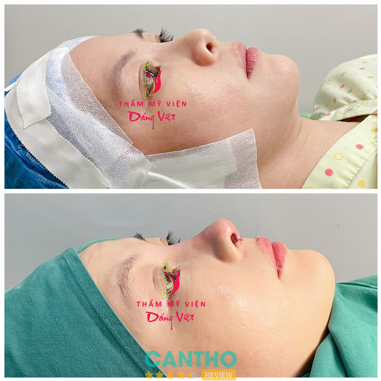 Thẩm Mỹ Viện Dáng Việt nâng mũi đẹp ở Cần Thơ