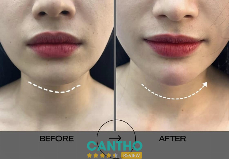 Địa chỉ tiêm Filler ở Vị Thanh  Nhiên Beauty