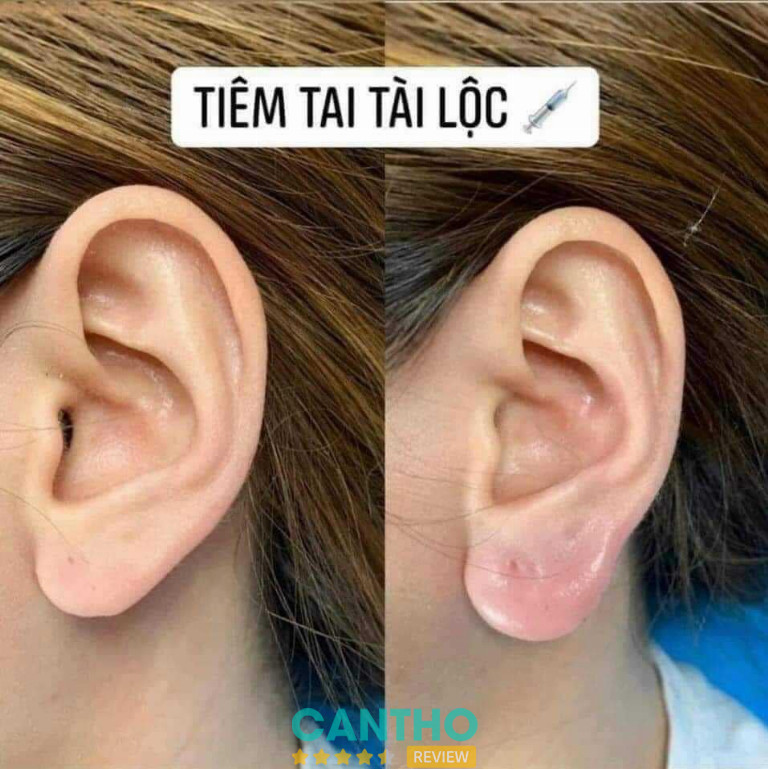 Địa chỉ tiêm Filler đẹp ở Vị Thanh  Thẩm mỹ Tuyết Trinh