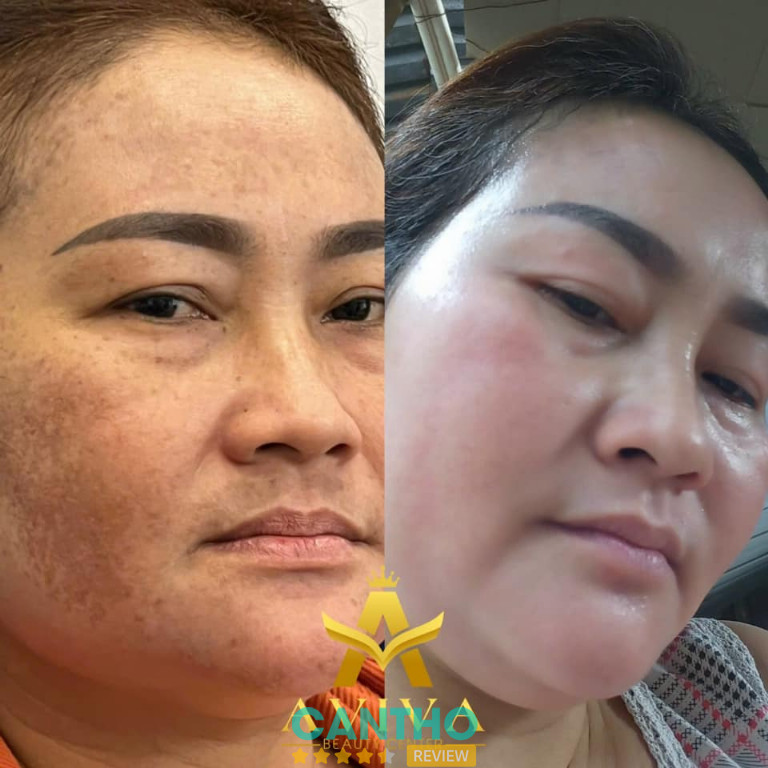 Địa chỉ trị nám da tàn nhang ở Ngã Bảy