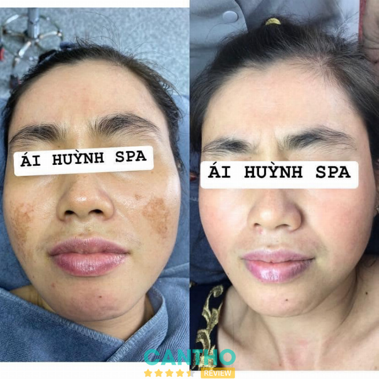 spa trị nám da tàn nhang ở Ngã Bảy