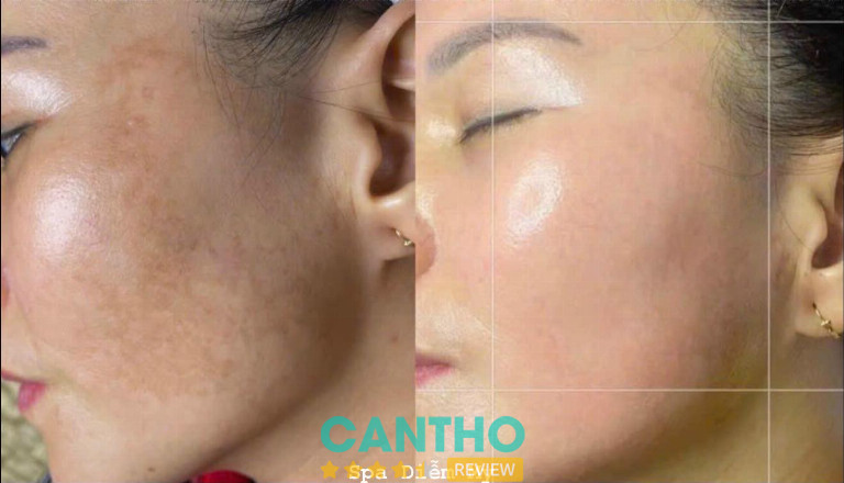 Spa Diễm My trị nám da tàn nhang ở Ngã Bảy hiệu quả