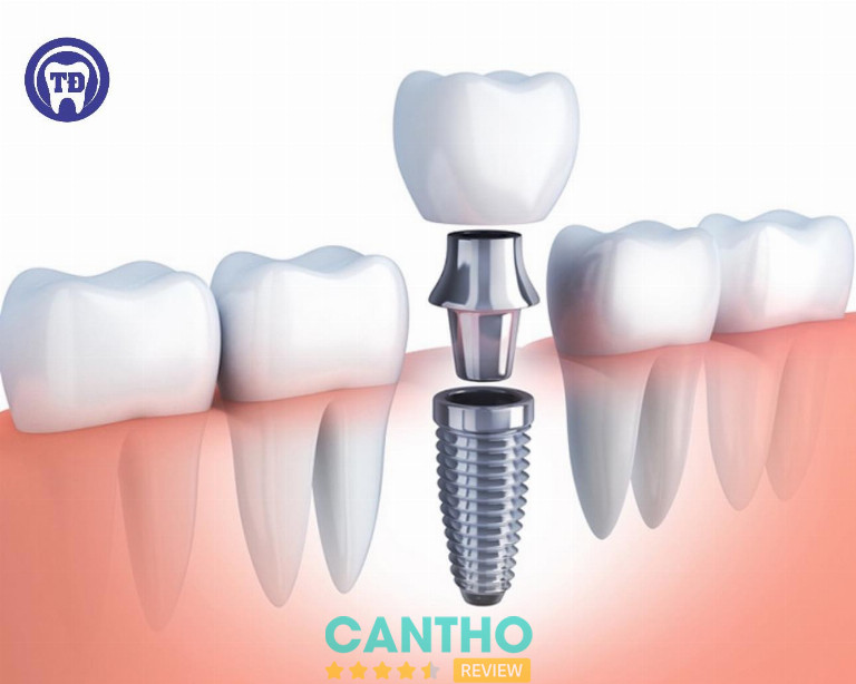 nha khoa Tâm Đức 2 trồng răng implant Ngã Bảy