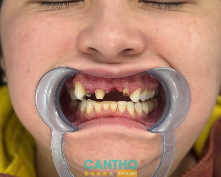 Nha Khoa An Khang trồng răng implant tại Ngã Bảy