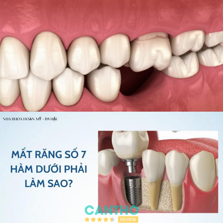 Nha Khoa Hoàn Mỹ trồng răng implant tại Vị Thanh giá rẻ