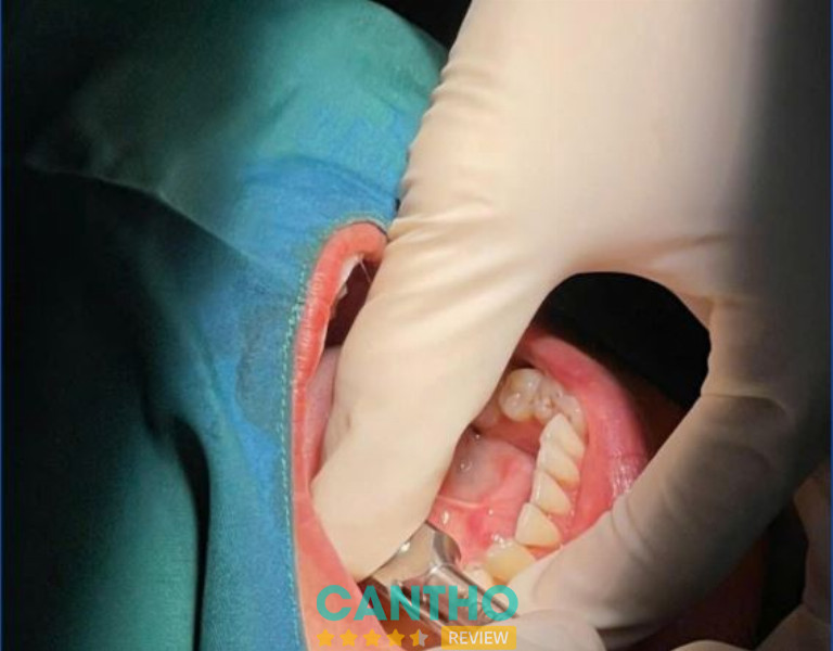 Nha Khoa Ninh Kiều trồng răng implant ở Vị Thanh