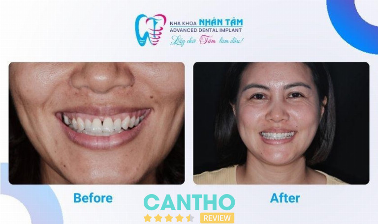 Nụ cười tự tin trở lại sau hành trình phục hồi răng mất bằng công nghệ Implant