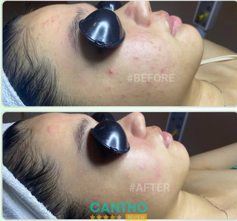 Nhiên Spa – hình ảnh dịch vụ lấy nhân mụn