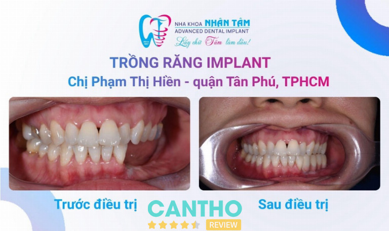 Nụ cười tự tin trở lại sau hành trình phục hồi răng mất bằng công nghệ Implant