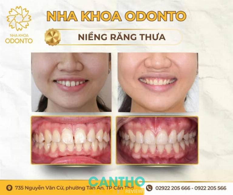 Nha Khoa ODONTO tại 735 Nguyễn Văn Cừ Tân An Cần Thơ